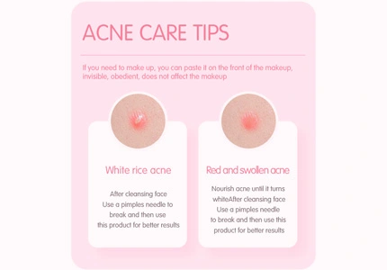 acne treatment