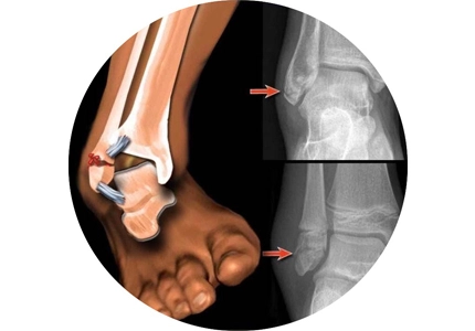 Fracture Immobilization