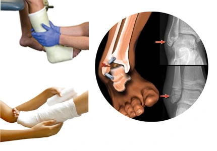 Fracture Immobilization