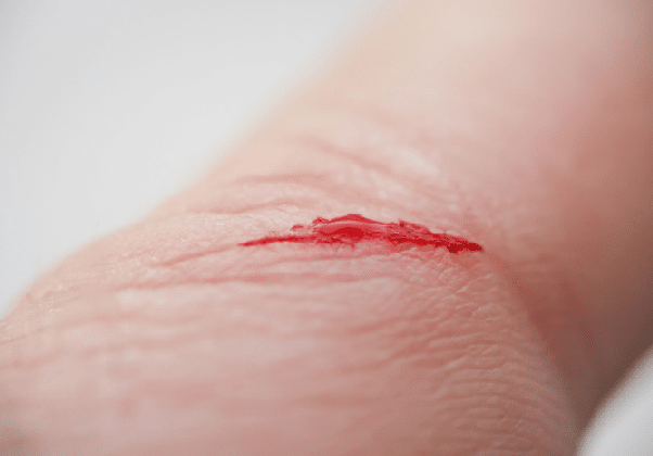 Traumatic wounds