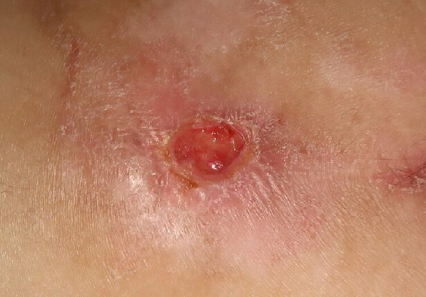 Chronic wounds