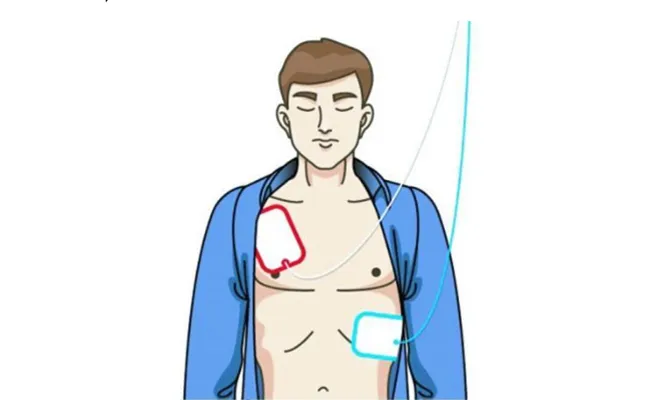 Apply the Electrode Pads